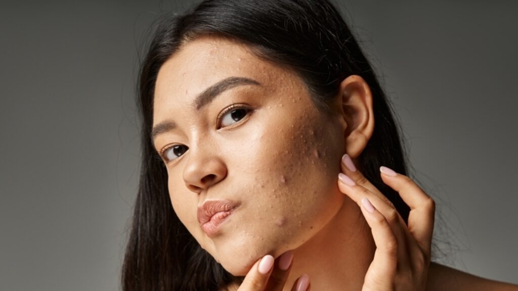 डर्मेटोलॉजिस्ट ने सुझाए, जबड़े और चिन की मुंहासों को कम करने के लिए 8 डाइट बदलाव